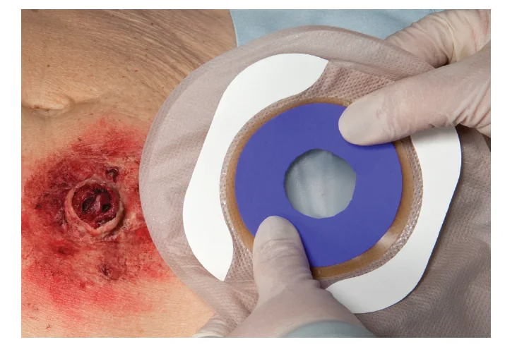 Clinician applying Hydrofera Blue CLASSIC Ostomy Dressing